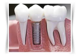 Implant Dentaire Marseille 13005